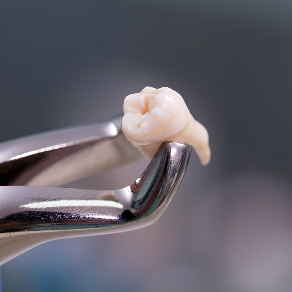 Image of a tooth after extraction: a small, ivory-colored object resting on a sterile surface, with slight traces of blood and a jagged base where it once connected to the gumline.