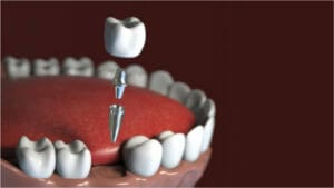 3D rendering of a dental implant, illustrating its placement and structure.