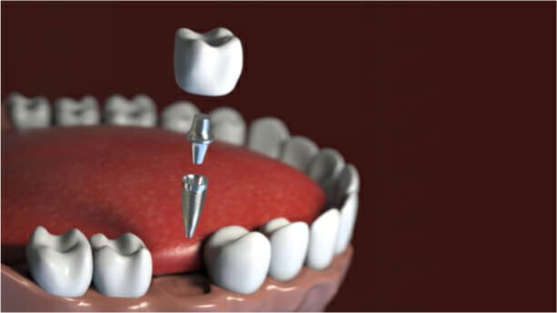 dental implants