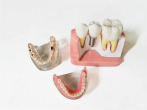 Visual demonstration of dental implants with various materials, showcasing options such as titanium, zirconia, and ceramic for tooth implant procedures.