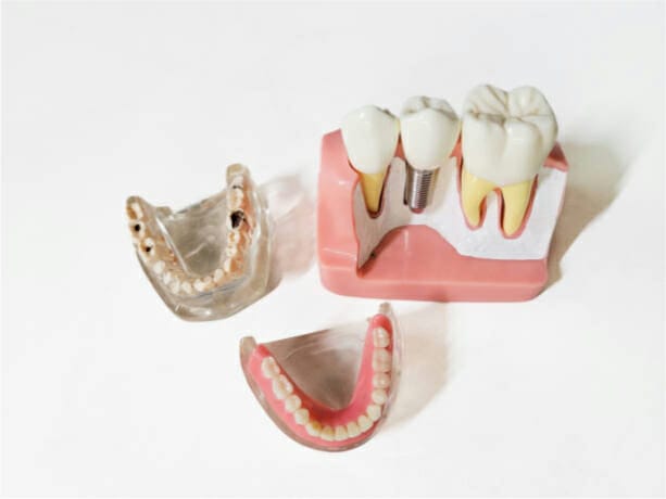 different types of dental implants