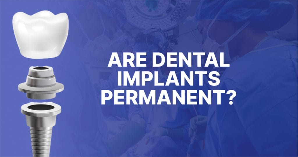 image text: are dental implants permanent?