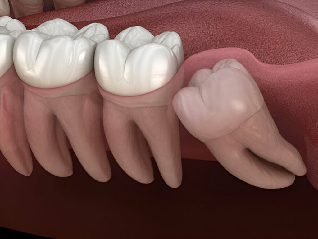 Visual depiction of impacted teeth exposure: A surgical scene with dental tools and equipment, showcasing the careful manipulation of tissue to reveal the hidden impacted teeth beneath the gumline, providing a clear view for further treatment.