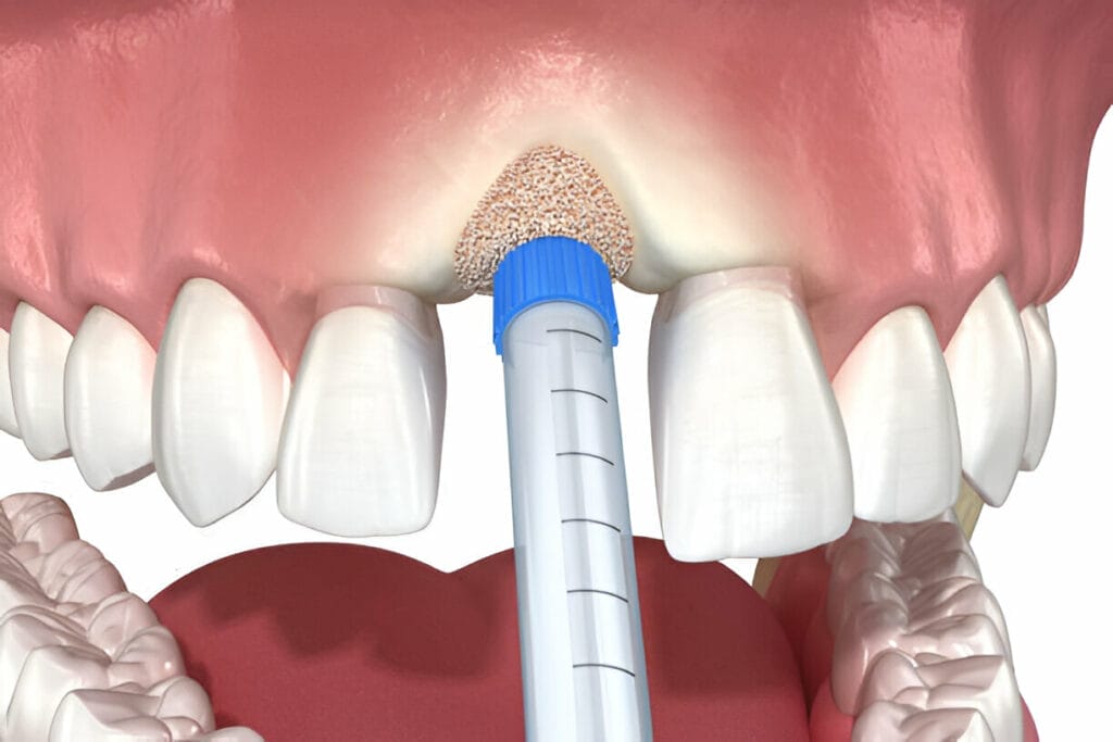 3D dental visualization of bone grafting procedure: Computer-generated rendering illustrating the precise placement of bone graft material into the jawbone defect