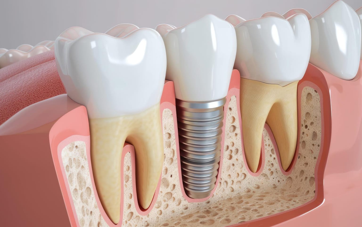 A cross-section illustration of a dental implant embedded in the jawbone between two natural teeth.