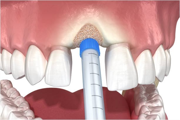 A 3D illustration showing a dental bone grafting procedure in the upper jaw, with a syringe-like tool inserting bone graft material into the area above the front teeth.