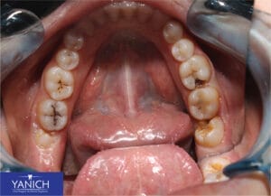 Close-up of dental patient with wisdom teeth